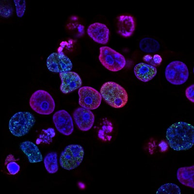 thrombolysis — thrombolyse