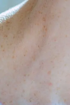 Moles — grains de beauté
