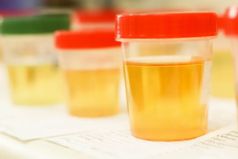 urine test — analyse d'urine