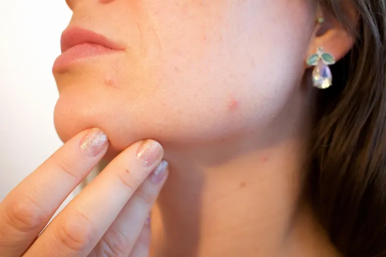 pimple — bouton