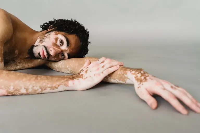 albinos — Albino