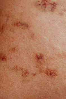 osip — rash