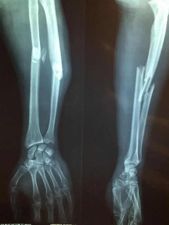 fracture — fracture