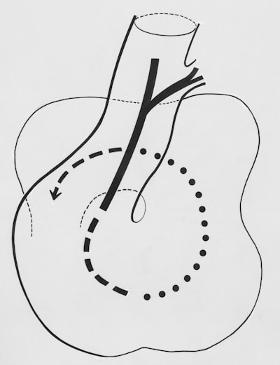 bypass — circunvalación