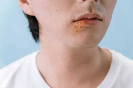 Ветряная оспа — chickenpox